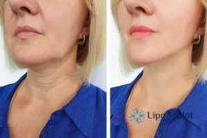 Double chin before and after Hi-Fu treatment 4 Book your double chin treatment Ely today! We are here to help!