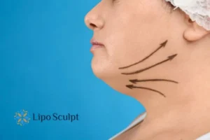 Double chin before and after Hi-Fu treatment 3 Boost your confidence with a Double chin treatment Ely