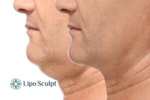 Double chin before and after Hi-Fu treatment 2 Double chin treatment Ely from Lipo Sculpt - feel more confident today!