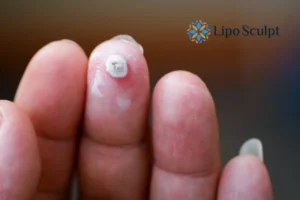 Cryopen Top 5 Treatable Conditions 4 Do you have a persistent wart of verruca that you cannot shit? Cryopen Ely treatment will work call us NOW!