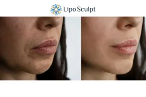 Morpheus8 Ely the best results - call our team today!